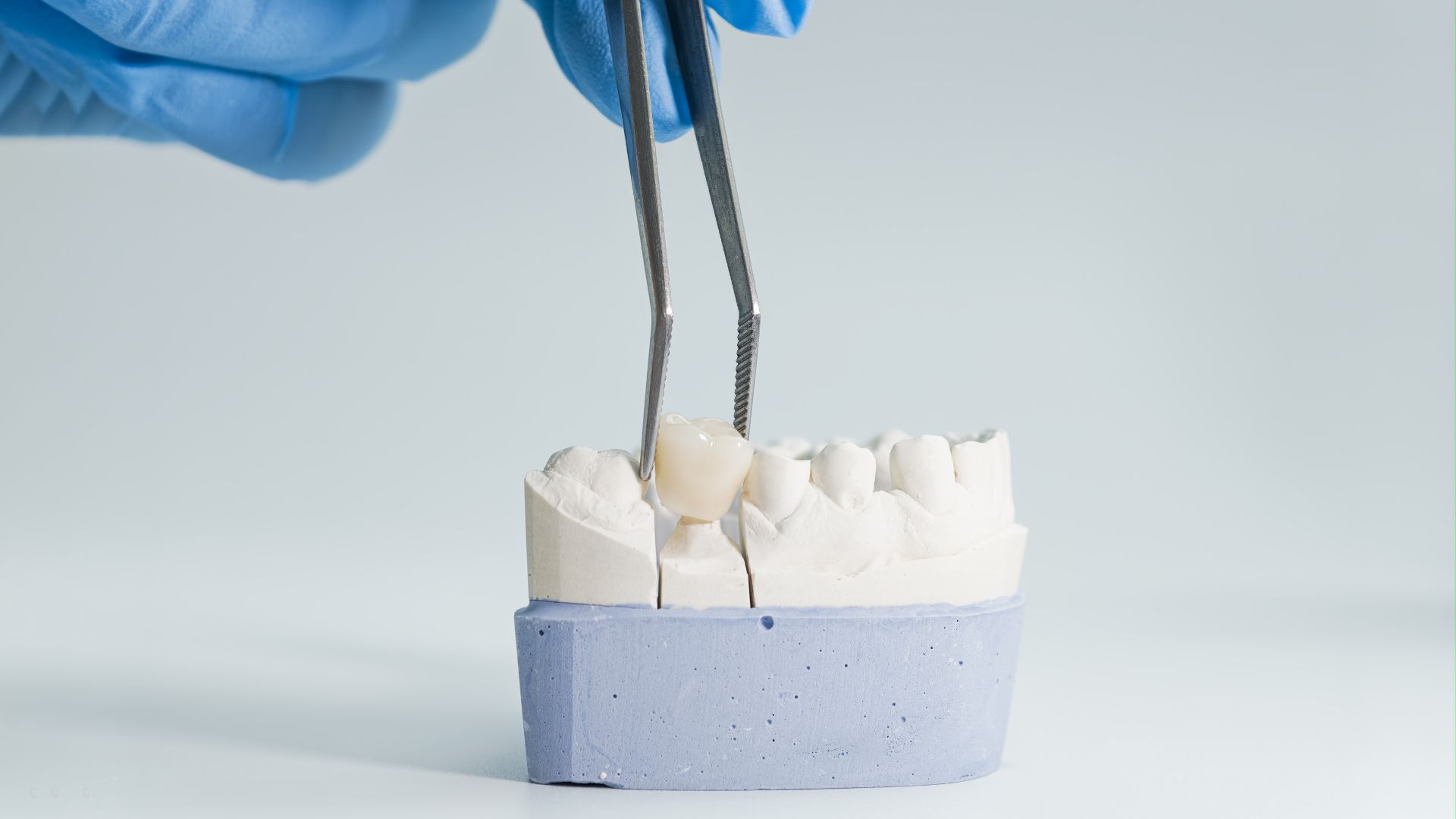 Dental Crown